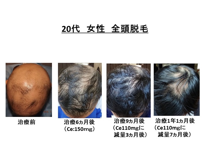 円形脱毛症　病院